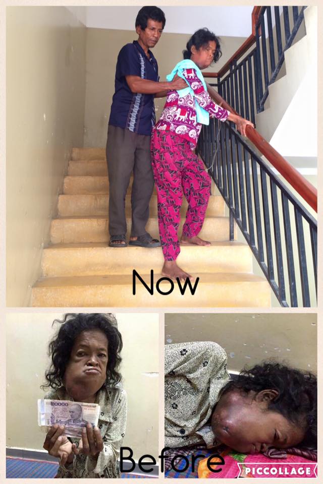 Having gotten financial support from Raksa Koma Foundation on supplementary food and medicine expenses, Ms. Nann Norn from Shihanuk Ville, who now is staying in Khmer-Soviet Friendship hospital, is getting much better